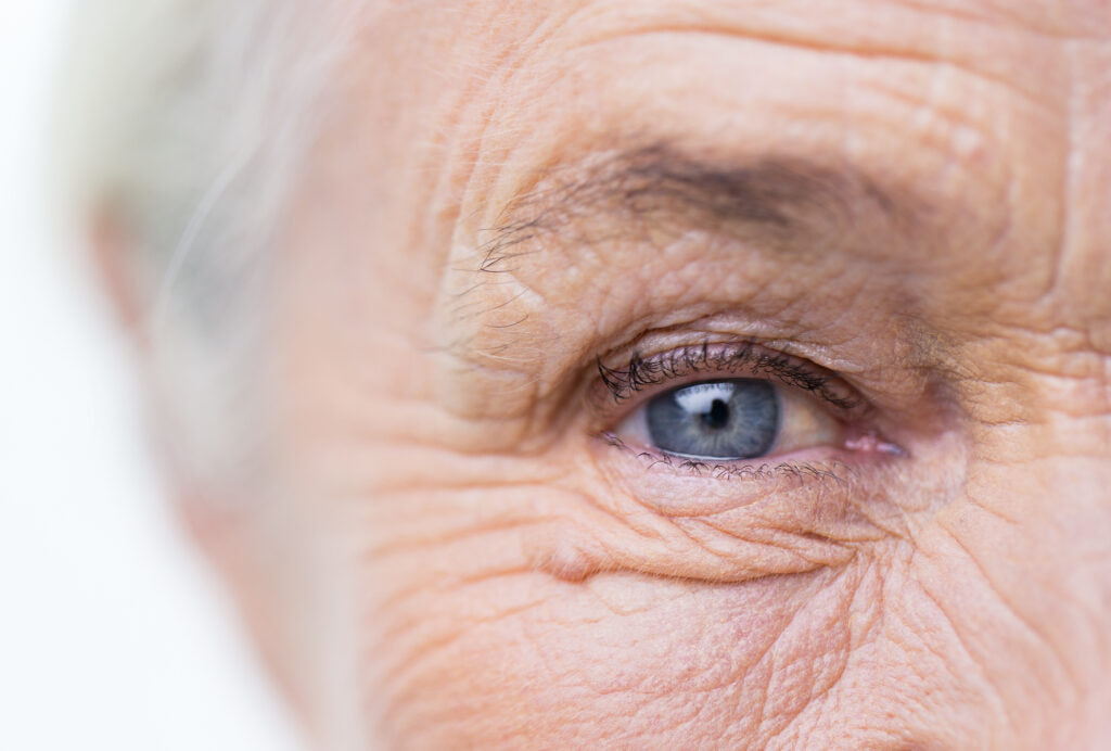 Eye with AMD Close-up of eye suffering from wet age-related macular degeneration.