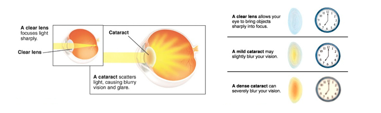 what-are-cataracts diagram-of-cataracts