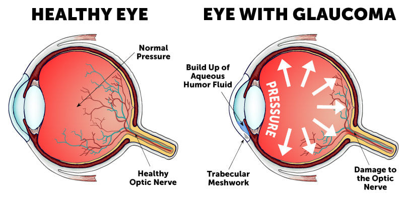 What is glaucoma? | Glaucoma Eye Diagram Glaucoma Symptoms | Ames Glaucoma Doctor