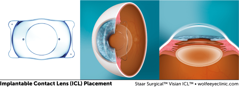 implantable-contact-lens-placement icl-placement-diagram