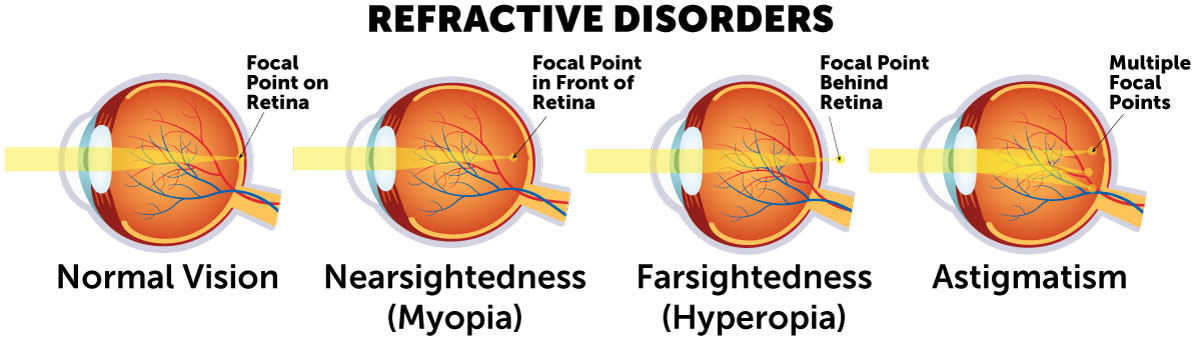 Diagrams of Refractive Disorders Refractive disorder diagram comparing cornea curvature and light refraction in myopia, hyperopia and astigmatism.