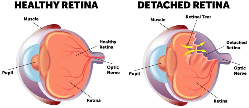 Detached Retina Diagram Detached retina diagram comparing a healthy retina to an eye with a retinal tear and retinal detachment.